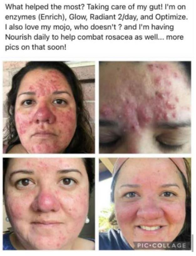 Tranont false claims acne